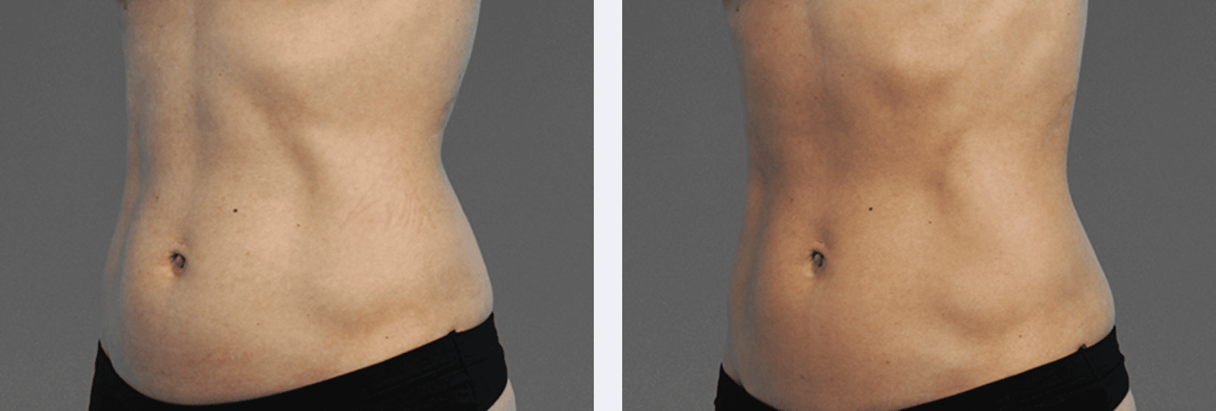 Before after CoolTone treatment, New York NY Image showing results from CoolTone treatment, a new body sculpting technology, New York City NY