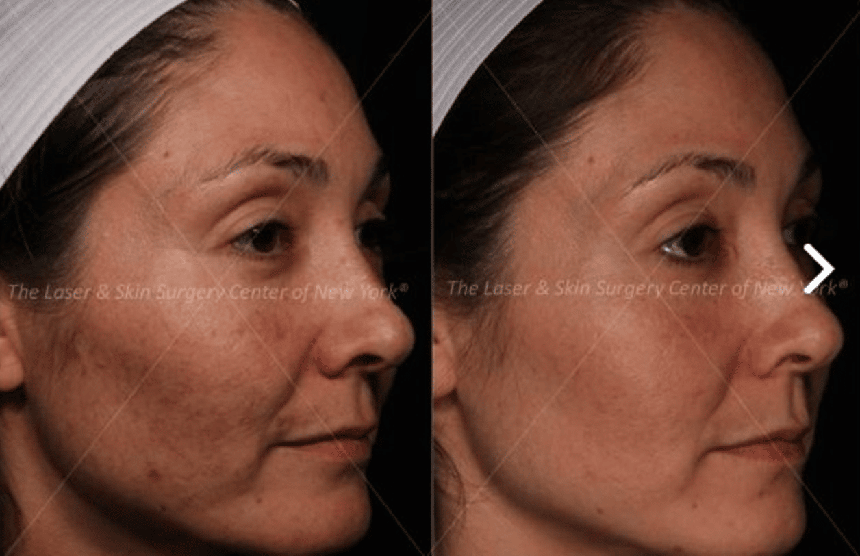 Face shot of a female patient showing her face with melasma and the results after treatment, New York City, NY