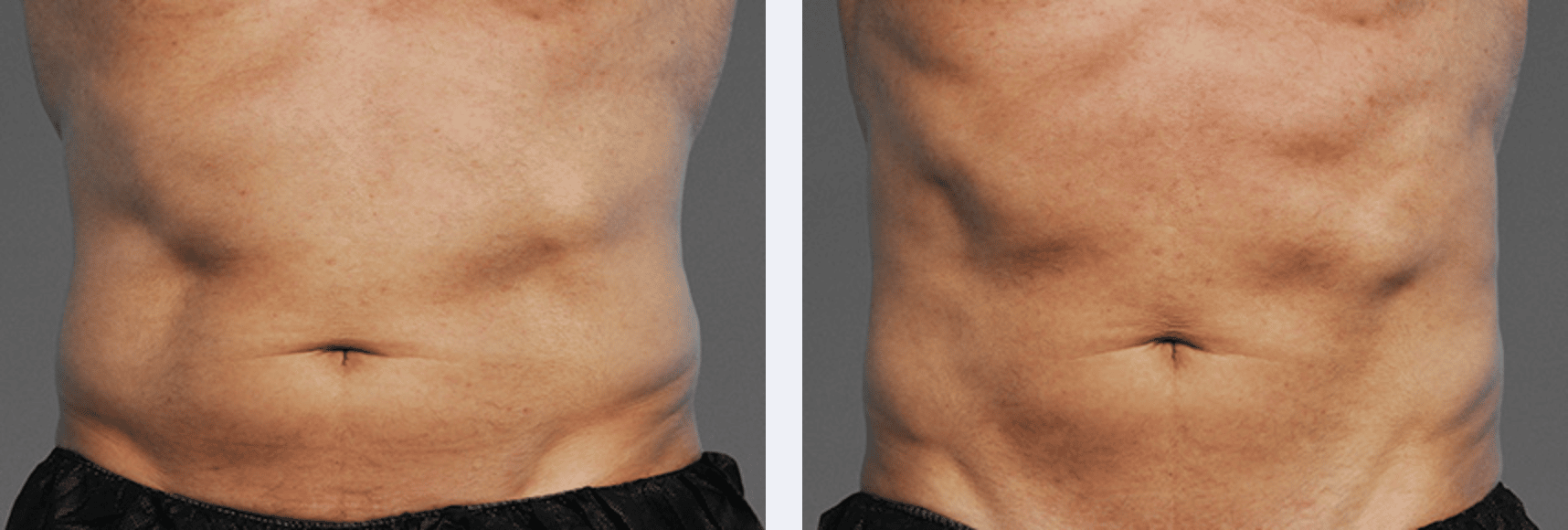 Before after body sculpting in New York, NY Image showing abs that look more in shape after a cooltone workout for body contouring, New York City, NY