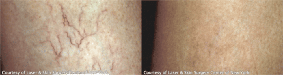 Varicose Leg Vein Treatment New York, NY | Laser Center