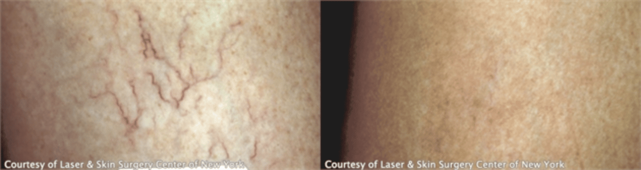Before and After treatment for varicose veins Laser and Skin Surgery Center of New York Image of leg with varicose veins and the results after the treatment, New York, NY