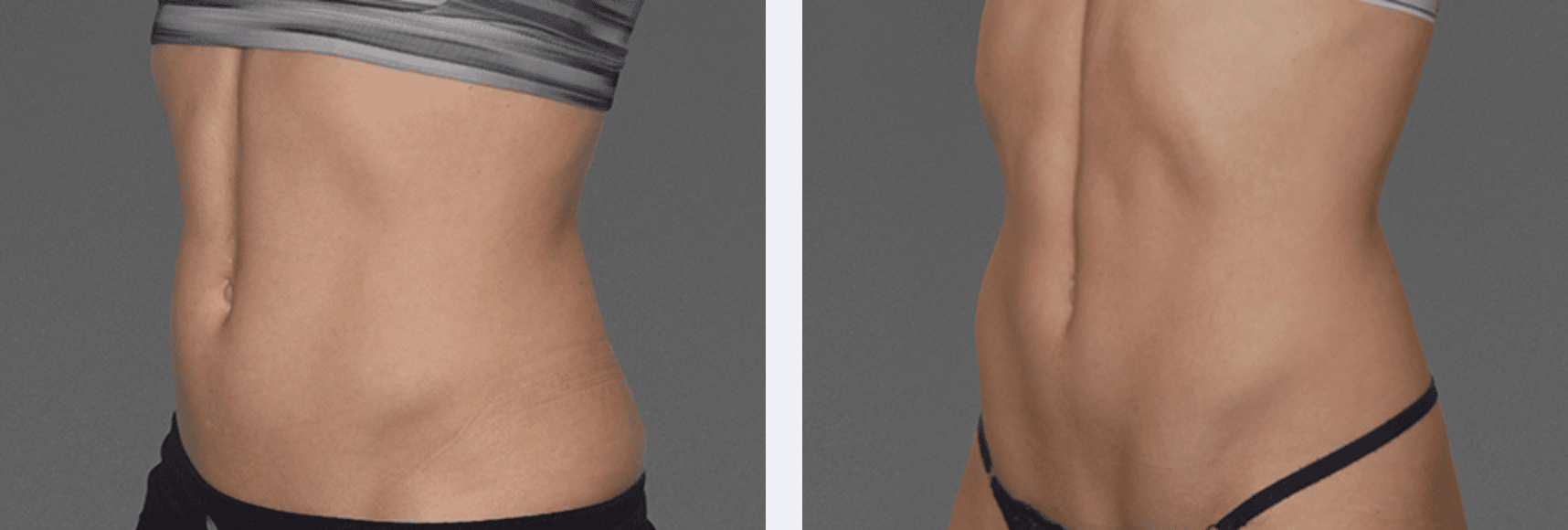 Image of a toned waist after it used new body sculpting technology, CoolTone, New York City, NY