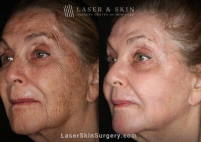 Sciton Erbium Contour Laser Treatment for Skin Rejuvenation