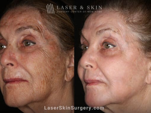 Sciton Erbium Contour Laser Treatment for Skin Rejuvenation