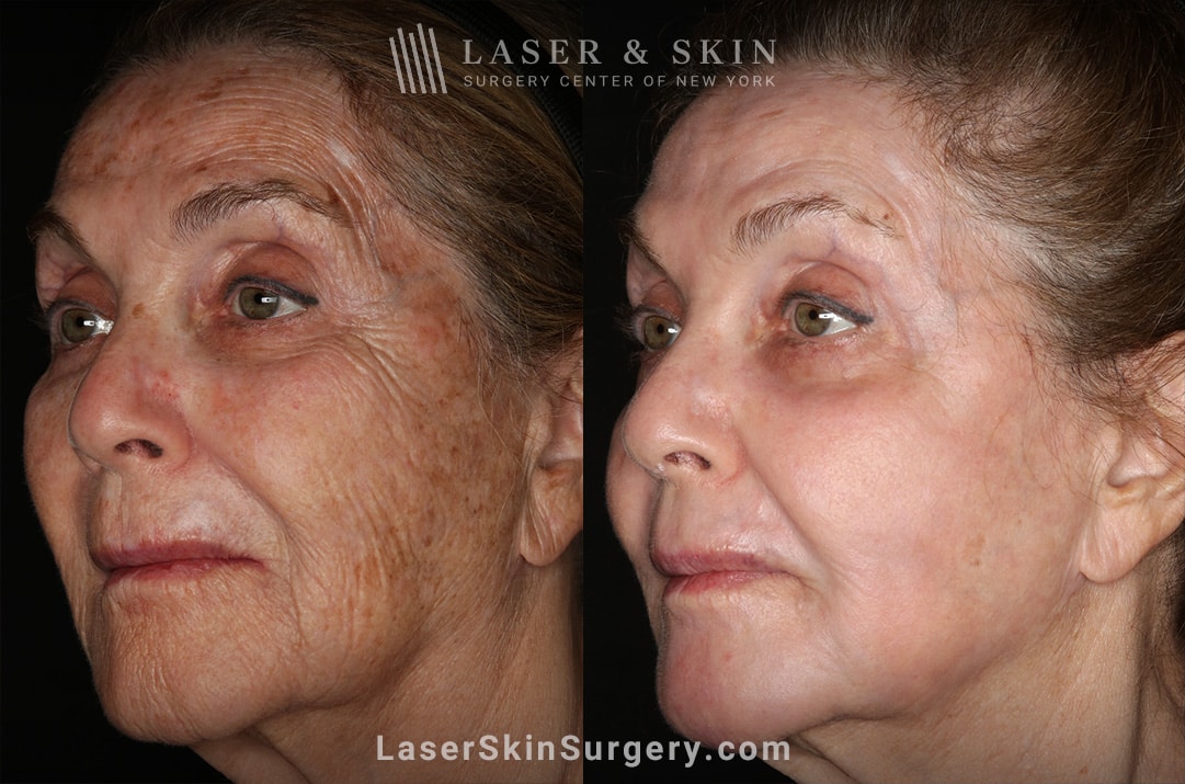 before and after image of a laser treatment for unwanted skin pigmentation also known as melasma on a woman's face