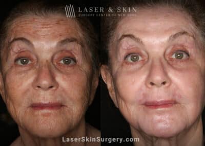 Sciton Erbium Contour Laser Treatment for Skin Rejuvenation