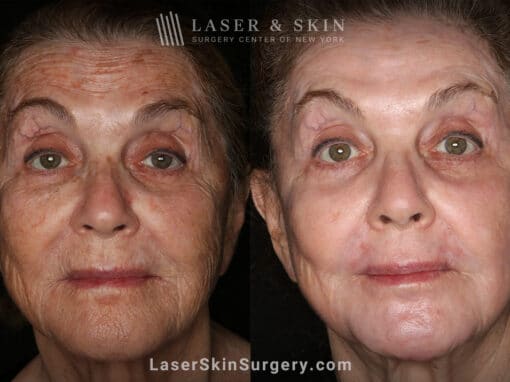 Sciton Erbium Contour Laser Treatment for Skin Rejuvenation