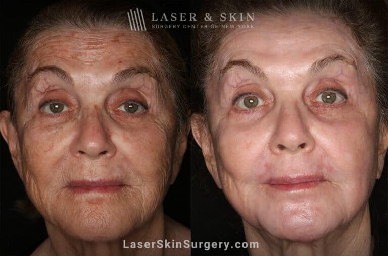 Sciton Erbium Contour Laser Treatment for Skin Rejuvenation