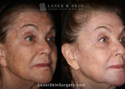 Sciton Erbium Contour Laser Treatment for Skin Rejuvenation