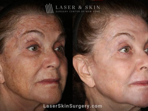 Sciton Erbium Contour Laser Treatment for Skin Rejuvenation