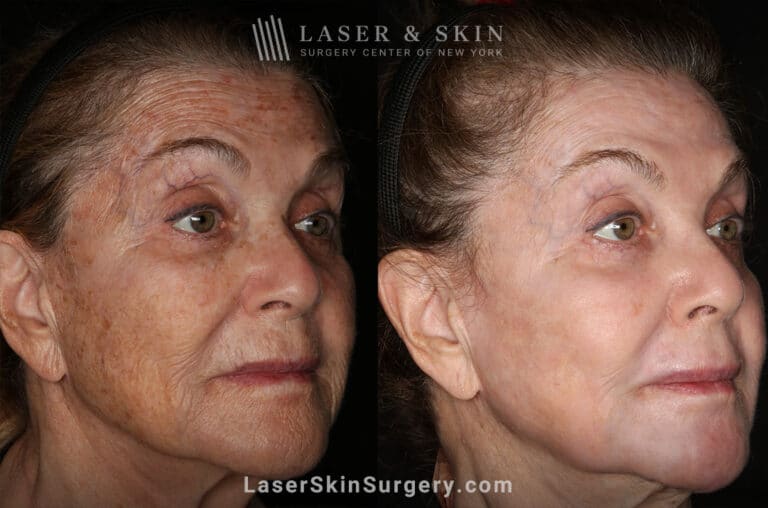 Sciton Erbium Contour Laser Treatment for Skin Rejuvenation