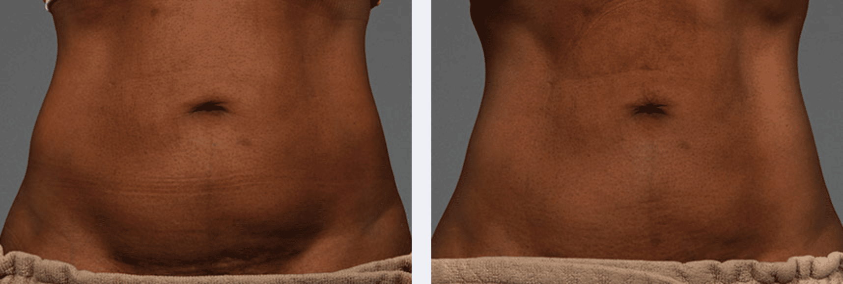 Fat loss with Cooltone for body contouring, New York, NY An image of male abdomen section loosing fat with the help of body contouring technique, CoolTone, New York City, NY