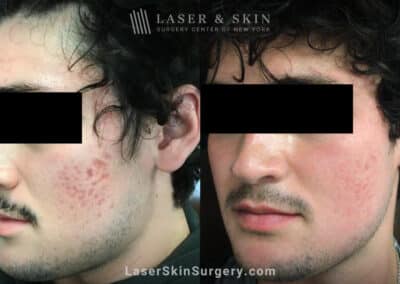 Fraxel and Vbeam used to treat acne scarring