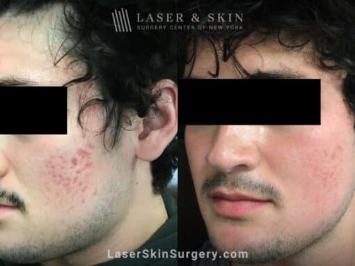 Fraxel and Vbeam used to treat acne scarring