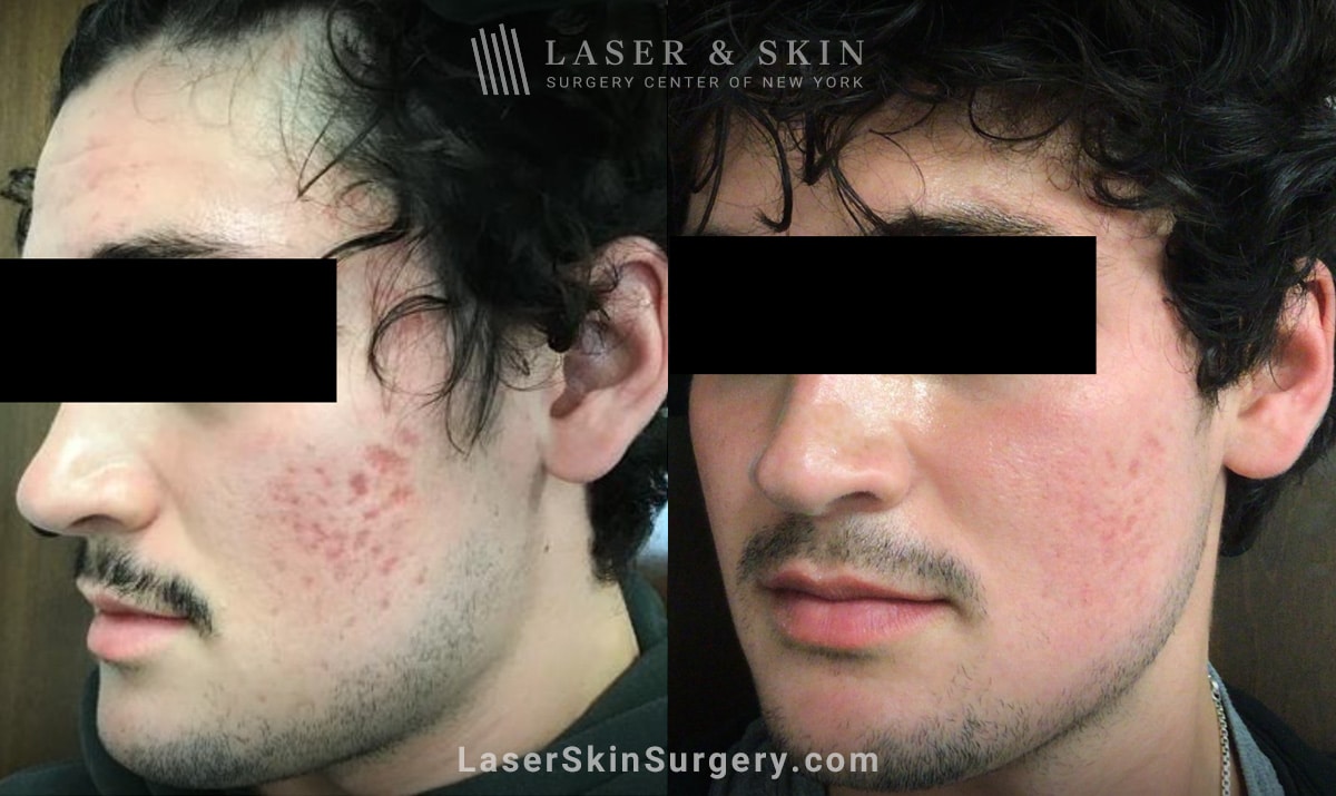Acne & Acne Scar Treatment New York, NY Laser Center