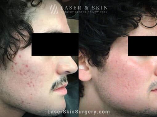 Fraxel and Vbeam used to treat acne scarring