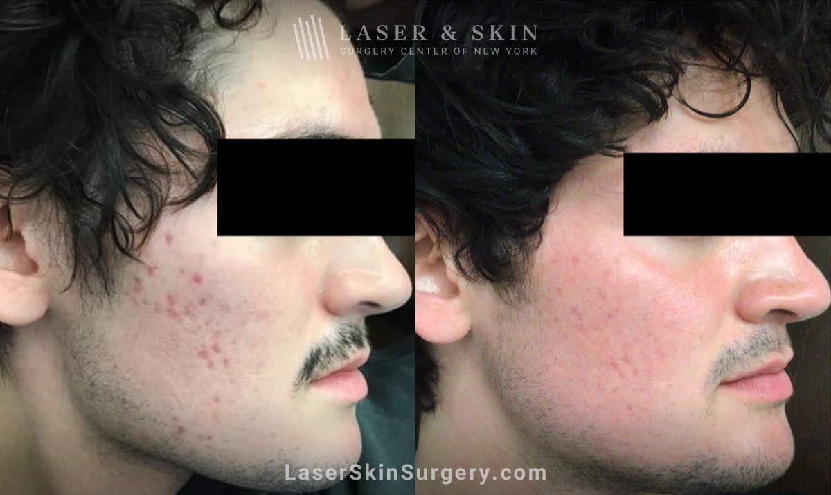 ice pick acne scars before and after treatment in new york