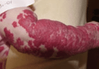 Image of a child's arm filled with red birthmark, Hemangiomas