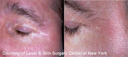 Hypopigmentation in New York, NY Image of a face of a male suffering from Hypopigmentation