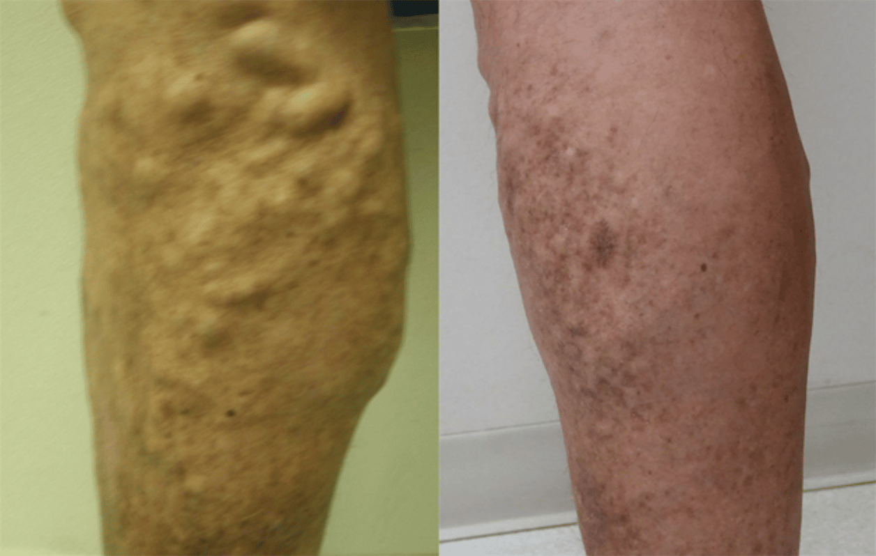 Leg veins and venos disease Laser and Skin Surgery Center of New York Image of a leg with Leg veins and after the treatment, New York, NY