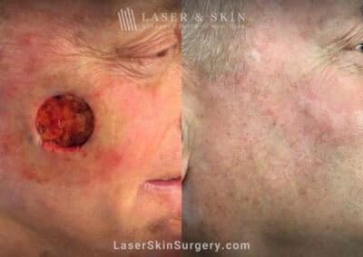 Mohs surgery to treat skin cancer on cheek – 5 years later