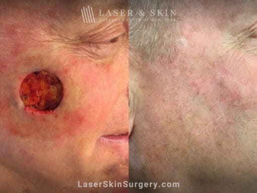 Mohs surgery to treat skin cancer on cheek – 5 years later