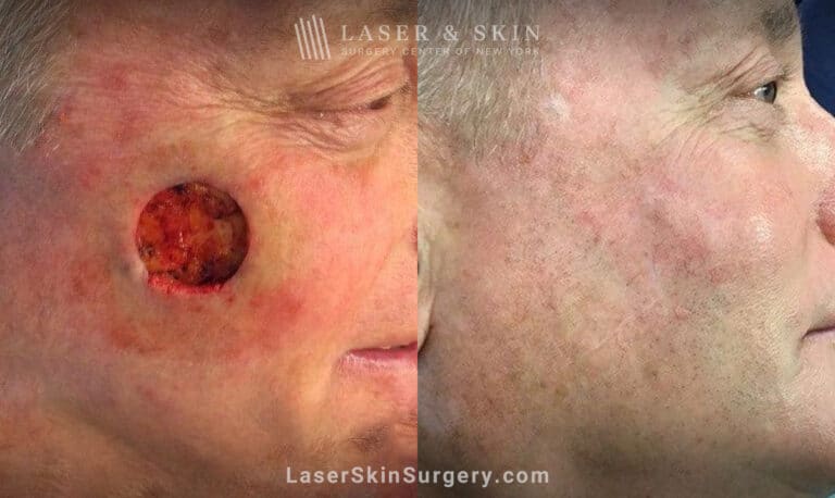 Mohs surgery to treat skin cancer on cheek – 5 years later