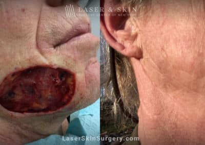 Mohs Surgery for Skin Cancer – 13 months later
