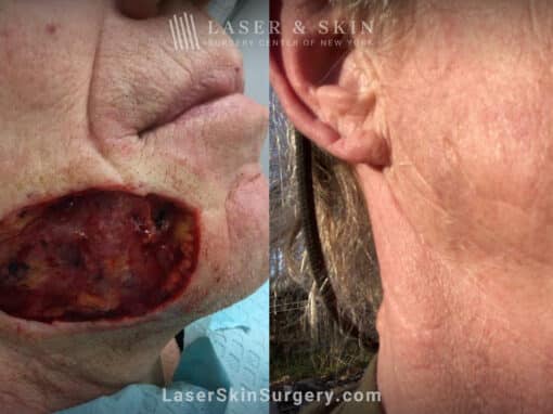 Mohs Surgery for Skin Cancer – 13 months later