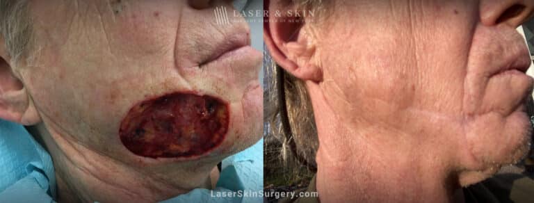 Mohs Surgery for Skin Cancer – 13 months later