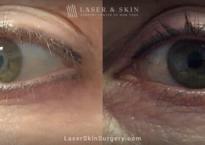 PicoPlus laser to remove permanent eyeliner