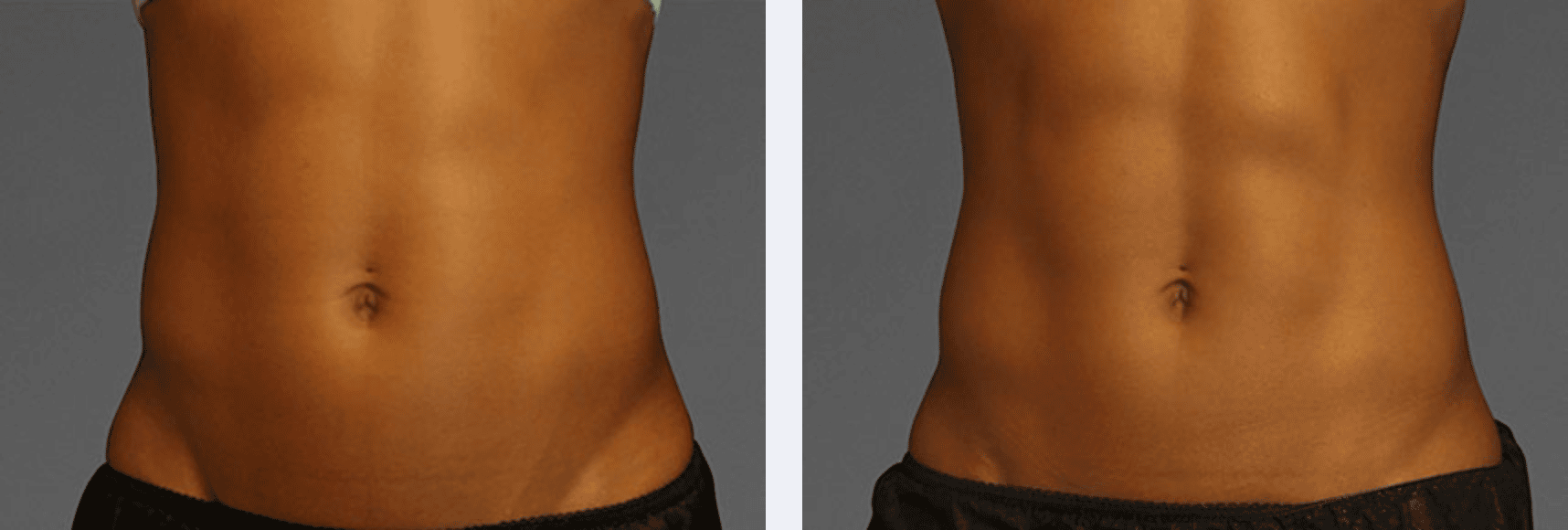 Image of abdomen that looks more in shape after using non-invasive and latest body sculpting treatment, New York City, NY