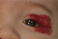 Image of an infant having Hemangiomas around his upper eye lid.