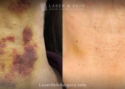 Vbeam laser to treat bruising after neck lift