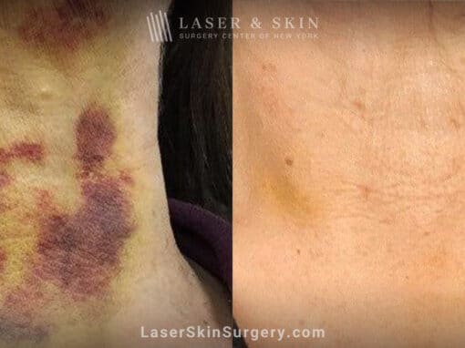 Vbeam laser to treat bruising after neck lift