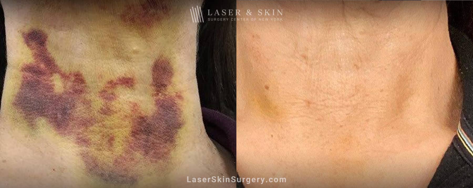 Vbeam-to-treat-bruising-after-neck-lift-LSSC-NYC fully recovered necklift results