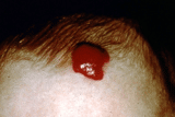 Image of a child's forehead with a red birthmark named, Hemangiomas, New York City, NY