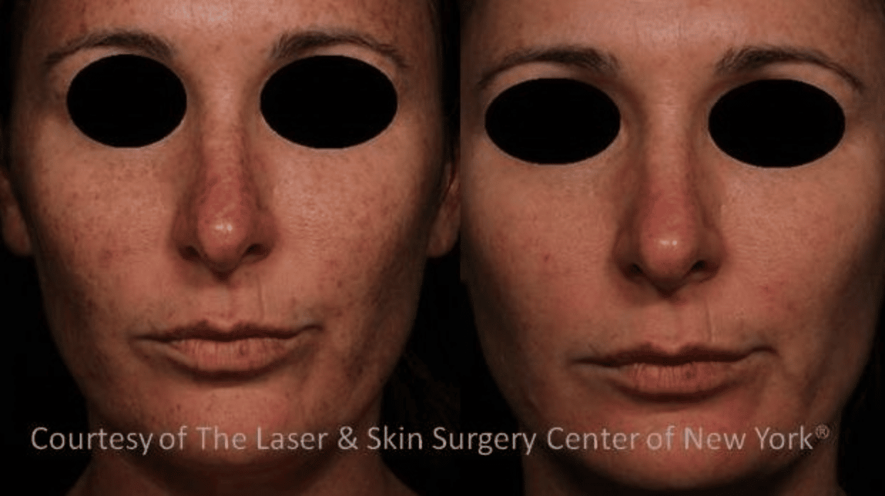 results after treating melasma Image showing melasma spots removed from the face of a female patient after the treatment, New York City, NY