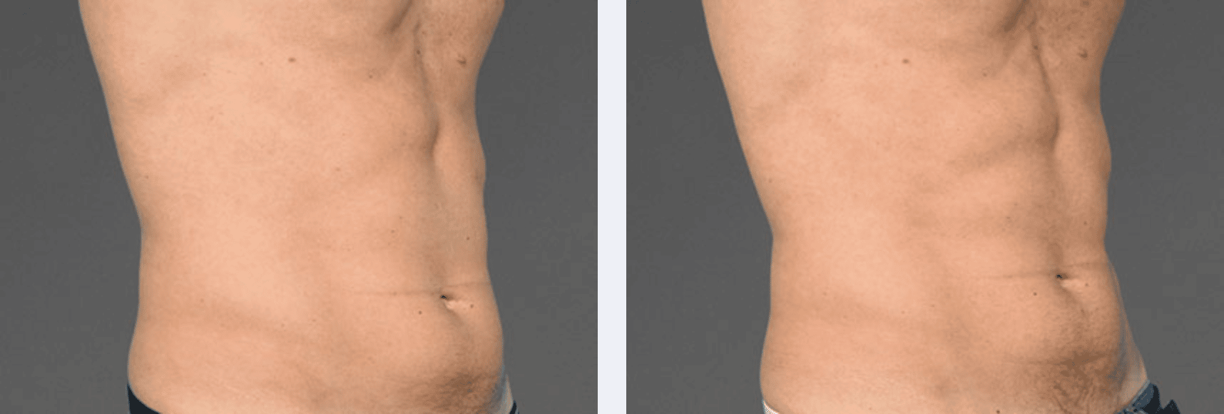 results after using latest body contouring technology, New York, NY Image showing toned abdomen area after 4-6 weeks using cooltone for body toning, New York City, NY