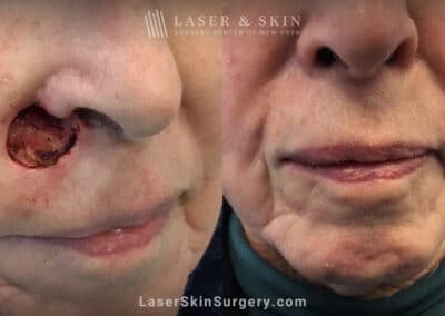 Mohs Surgery to Treat Skin Cancer near the Nose
