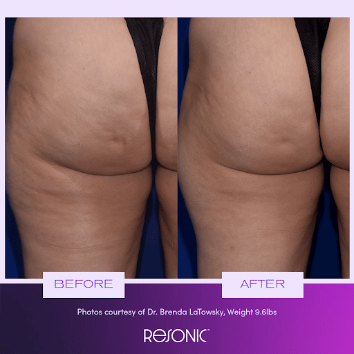 benefits of resonic cellulite treatment-NYC-NY cellulite treatment results from Resonic device in NY, NY