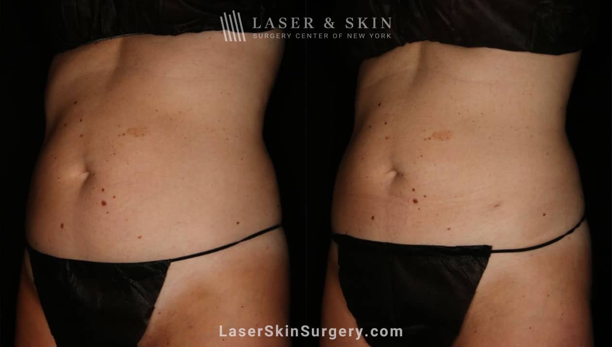 liposculpture body contouring results NYC