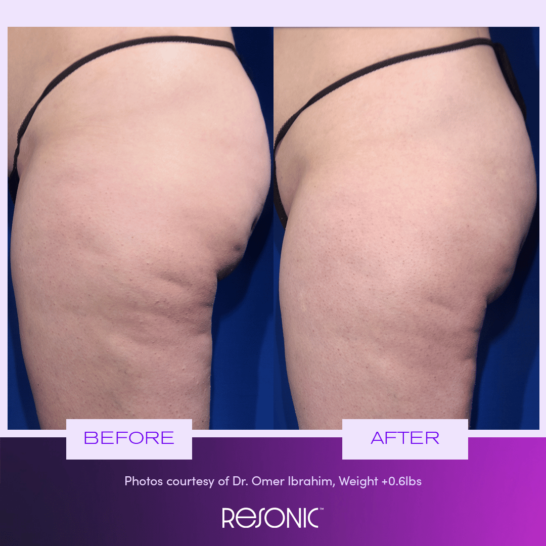 Resonic cellulite treatment results in NY, NY