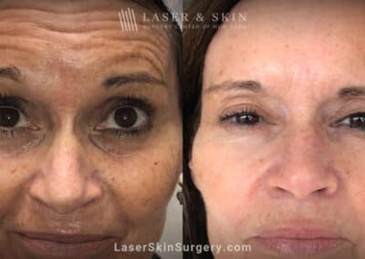 Before and After Botox to Removal Forehead Wrinkles