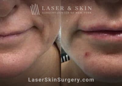 Lip filler to add fullness and improve the shape of the lips