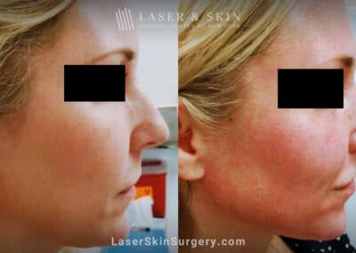 Filler injections to improve nose shape and profile