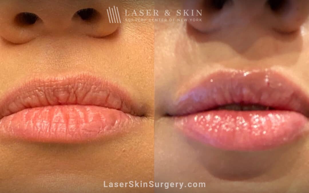 lip fillers before and after