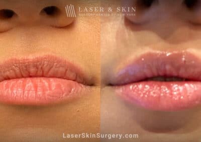 Filler Injections to Add Volume and Symmetry to Lips