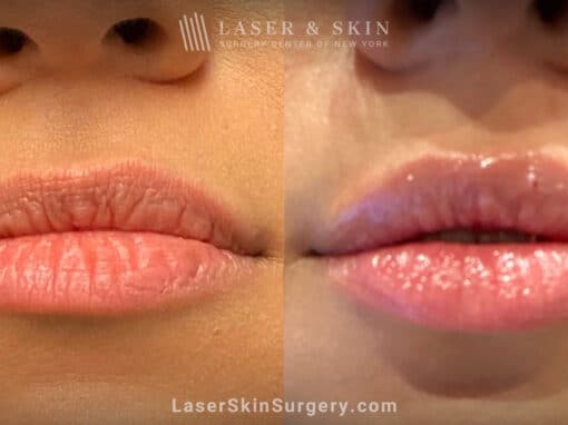 Filler Injections to Add Volume and Symmetry to Lips