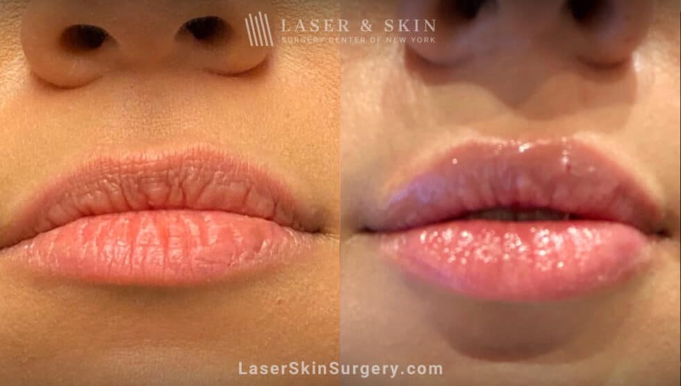 4 Ways to Prevent Lips from Getting Smaller, from Expert Dermatologists ...